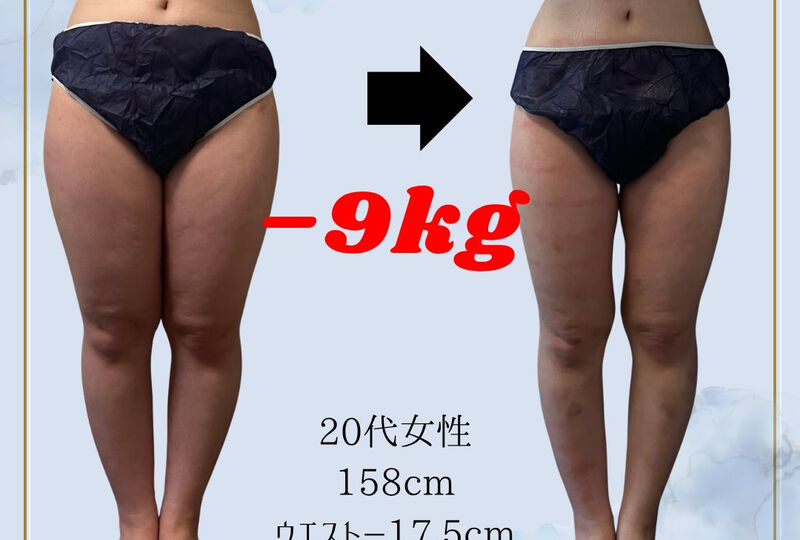 画像20755：足痩せをしたいなら、彦根の成宮鍼灸整骨院へ🐘🩵